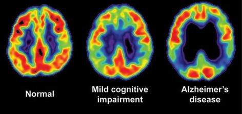 Signs Of Alzheimer's, Psychological Testing, Brain Images, Pet Scan, Healthy Holistic Living, Brain Scan, Mri Scan, Blood Test, Neurology