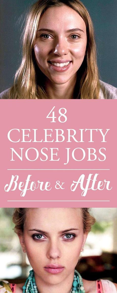 Celebs With Big Noses, Best Rhinoplasty Before After, Big Noses Women, Celebrities With Big Noses, Wide Nose Women, Women With Big Noses, Nose Job Before And After, Big Nose Women, Celebrity Nose Jobs