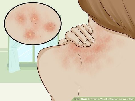 Yeast Infection Home Remedies, Skin Rash Remedies, Body Health Tips, Yeast Infection On Skin, Rashes Remedies, Candida Yeast Infection, Homemade Facial, Candida Overgrowth, Home Remedies For Skin