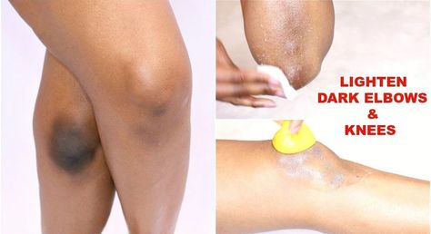 How To Lighten Knees, Dark Elbows And Knees, Dark Spots Under Armpits, Dark Spots On Legs, Dark Knees, Dark Knuckles, Dark Elbows, Lighten Skin Tone, Spots On Legs