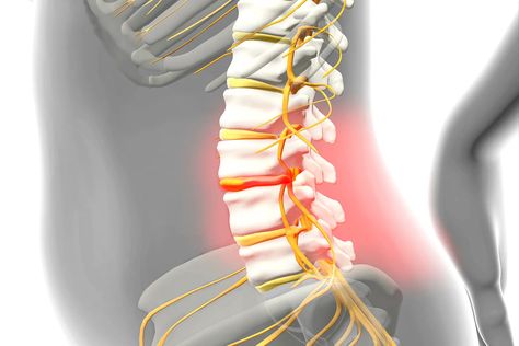 Do I Have a Herniated Disk? Herniated Disk In Lower Back, Bulging Disc, Disk Herniation, Nerve Damage, Spinal Cord, Aids Hiv, Aging Well, Muscle Pain, Lower Back