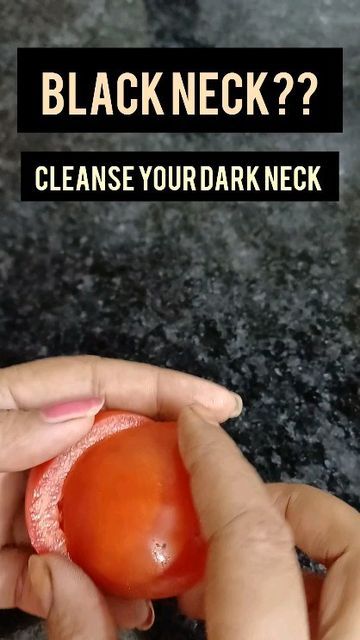 How To Remove Sunburn, Dark Spots On Neck, Dark Neck Remedies, Pigmentation Remedy, Sunburn Peeling, Dark Neck, Energy Boosting Foods, Skin Care Home Remedies, Healthy Heart Tips