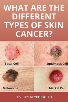 Basal Cell, Skin Moles, Squamous Cell, Types Of Skin, Health Planner, Breast Health, Skin Disorders, Types Of Cancers, Skin Diseases