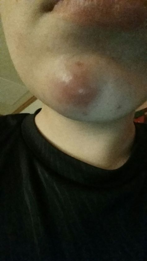 I have this HUGE pimple on my chin and it is quite painful. Does anyone have a remedy? Zit Remedy, Huge Pimple, Painful Pimple, Big Pimple, How To Get Rid Of Pimples, Healthy Juice Recipes, Ingrown Toe Nail, Useful Life Hacks, Body Positivity