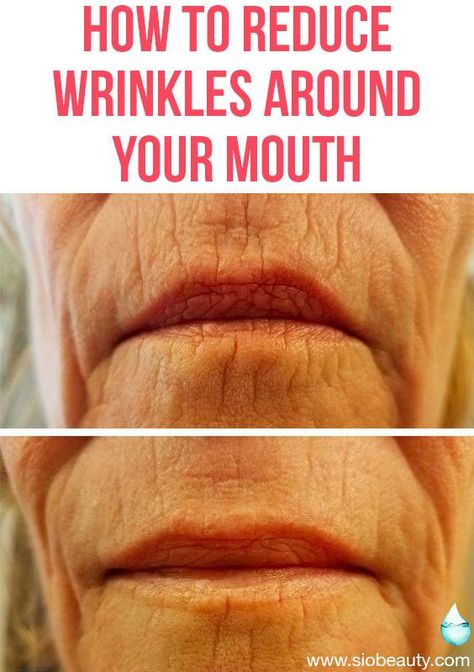 LIP LINES TREATMENTS - In this article we'll explain what lip lines are and what causes them to form. Then we’ll reveal the seven best ways to get rid of those annoying wrinkles around your mouth so you can enjoy a younger-looking, more beautiful smile. Smokers Lines, Mouth Wrinkles, Antiaging Skincare, Wrinkle Remedies, Natural Hair Mask, Lip Wrinkles, Anti Aging Oils, Get Rid Of Blackheads, Smooth Lips