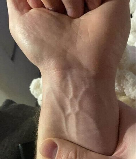 These People's Genetic Conditions Really Make Them Unique Cat Eye Syndrome, Anatomically Correct Heart, Visible Veins, Different Colored Eyes, Good Buddy, Baby Teeth, Genetic, Medical Conditions, One In A Million