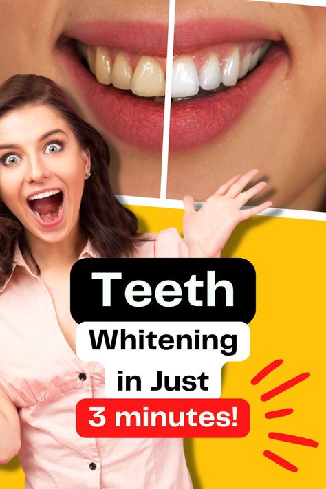 Before and after teeth whitening V34 Colour Corrector, Colour Corrector, Whitening Teeth, Teeth Bleaching, Perfect Teeth, Gum Care, Natural Teeth Whitening, The Dentist, Perfect Smile