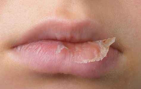 3 Common Lip Balm Ingredients That Irritate Your Lips Hives Remedies, Lip Balm Ingredients, Hydrocortisone Cream, Flaky Skin, Unwanted Hair Removal, Dior Addict, Chapped Lips, Unwanted Hair, Your Lips