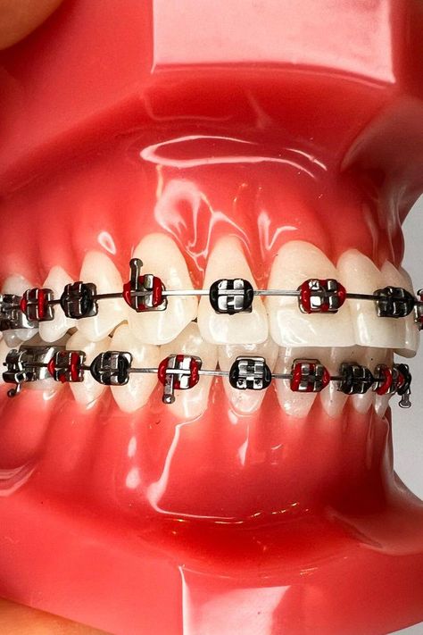 Red Braces Color, Red And Black Braces, Braces Color Combos, Braces Combos, Black Braces Bands, Braces Journey, Braces Colors Combinations, Red Braces, Silver Braces