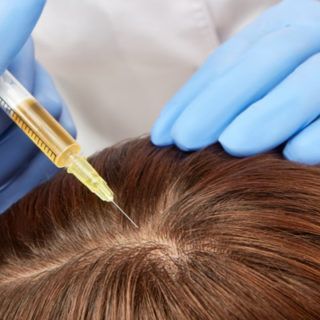 platelet rich plasma Hair Regrowth Remedies, Hair Regrowth Women, Prp Hair, Hair Transplant Cost, Natural Hair Regrowth, Hair Growth For Men, Help Hair Grow, Hair Growth Shampoo, New Hair Growth