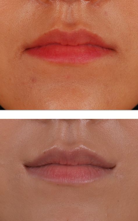 Corner Lip Lift, Lip Corner Lift, Lipstick Guide, Lip Lift, Korean Lips, Smile Lines, Contour Line, Aesthetic Clinic, Stage Makeup