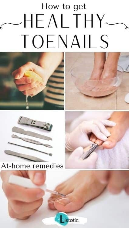 Learn how to get healthier toenails with this list! Read everything from proper trimming techniques to how to get rid of toenail fungus using home remedies. Click on the pin to see the full guide to toenail care featured on Listotic! Brittle Toenails, Toenail Care, Healthy Toenails, Toenail Health, Nail Whitening, Ingrown Toenail, Fungal Nail, Brittle Nails, Ingrown Toe Nail