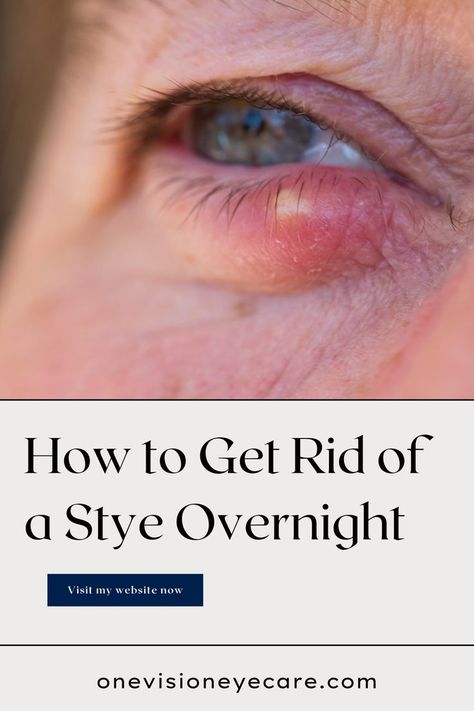 A lot of things can cause a stye, and some are completely in your control. In this article, I am going to cover things you can do to help prevent styes and at the end I’ll give you my tip on how to get rid of a stye overnight. Sty Remedy How To Get Rid, Sty In The Eye Remedies How To Get Rid, Get Rid Of A Stye Overnight, How To Get Rid Of A Stye On Your Eyelid, Remedies For Stye On Eyelid, What Causes A Stye In Your Eye, How To Get Rid Of Stye Eye, Swollen Under Eye Remedies, Sty Eye Remedies How To Get Rid