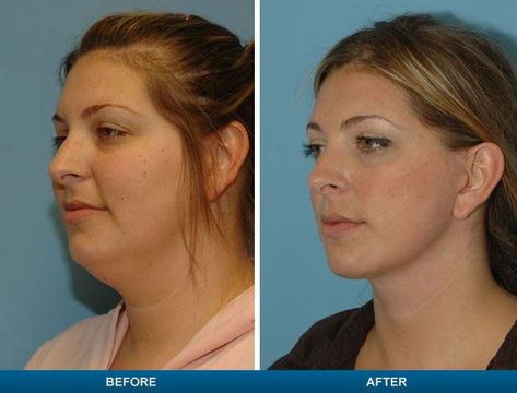 double chin face fat Double Chin Surgery, Neck Lift Surgery, Lipo Before And After, Fitness Before And After Pictures, Reduce Face Fat, Double Chin Removal, Double Chin Exercises, Chin Exercises, Face Lift Surgery