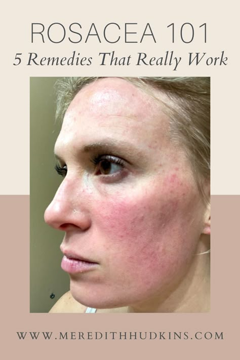 Get Rid Of Facial Redness, Skin Care Treatments Faces, Redness Reducing Skin Care Natural, Skincare For Rocesea, Facial Redness Remedies, Get Rid Of Redness On Face, Rosatia Remedies, Face Redness Remedy, Roscea Help