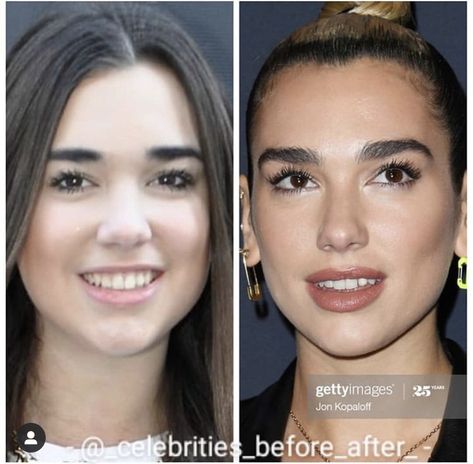 Before and after Dua Lipa Before And After, Celebrity Before And After Surgery, Celebrities Before And After Surgery, Lip Surgery Before And After, Celebrity Plastic Surgery Before After, Cheek Fillers Before And After Face, Dis Lipa, Face Plastic Surgery, Celeb Hair