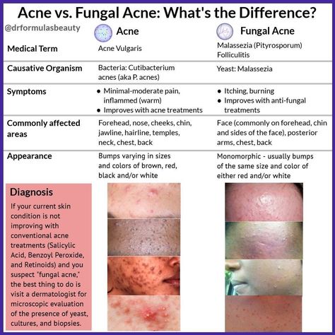 Skincare Science, Forehead Acne, Fungal Acne, Acne Vulgaris, Love Oil, Medical Terms, September 16, Skin Care Treatments, Wellness Tips