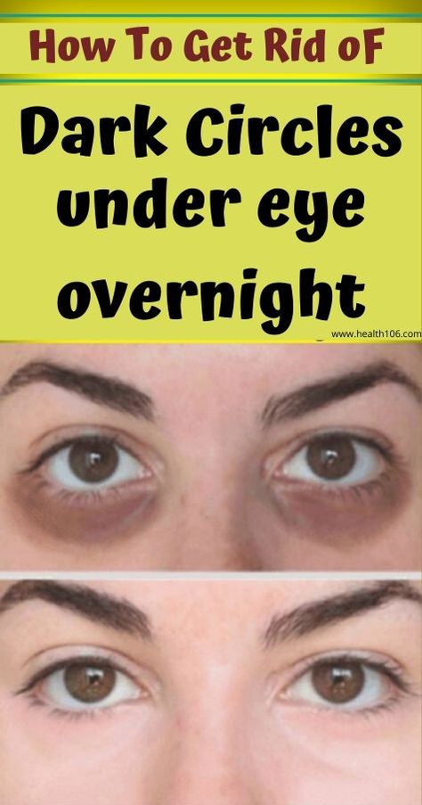 How to get rid of dark circles under eyes overnight. Two girls getting rid of eye bags and under eye circles ... For every late night chatting over drinks, for every day out in the sun and for every bed Dark Rings Under Eyes, Eye Circle Remedies, Rid Of Eye Bags, Dark Circle Remedies, Under Eye Circles, Wrinkle Remedies, Dark Eye Circles, Beauty Hacks Skincare, Makeup Tip