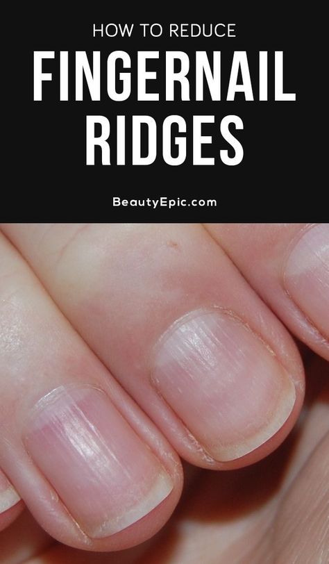 Find Out Whether Those Ridges On Your Fingernails Are Harmful Or Not Fingernail Ridges, Fingernail Health, Nail Remedies, Nail Ridges, Nail Infection, Nail Fungus Remedy, Fungal Nail, Tongue Health, Nail Care Tips