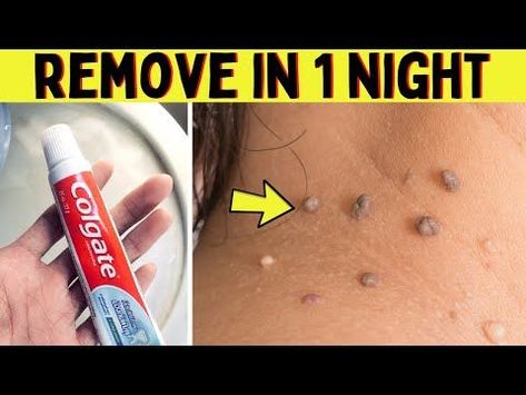 Best Way To Remove Skin Tags, Natural Remedies For Skin Tags, How To Naturally Remove Skin Tags, Warts Removal On Face, Diy Removal Of Skin Tags, Skin Mole Removal At Home, Remove Moles And Skin Tags, Diy Remove Skin Tags At Home, Home Remedy For Skin Tags