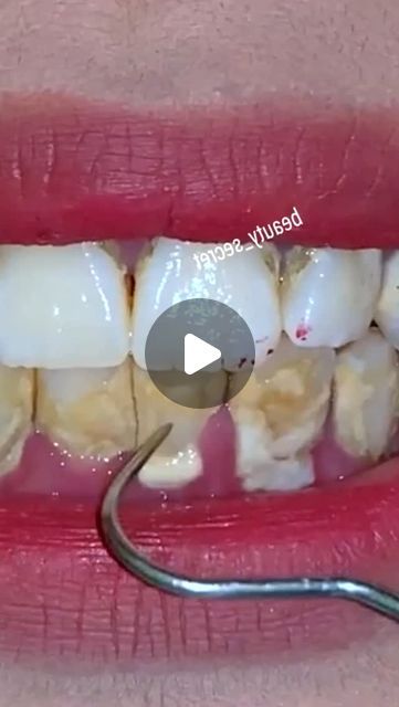 Healthy Tips on Instagram: "Teeth Whitening Remedy #teethwhitening #remedy" Cleaning Teeth With Baking Soda, Diy Teeth Cleaning At Home, How To Remove Plaque From Teeth At Home, Teeth Sensitivity Remedies, Teeth Cleaning Videos, Tartar Removal From Teeth, How To Whiten Teeth, Deep Cleaning Teeth, White Teeth Tips