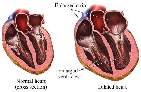 Enlarged Heart Symptoms, Enlarged Heart, Heart Valves, Normal Heart, Gene Therapy, Heart Problems, Heart Health, Heart Healthy, Organic Skin Care