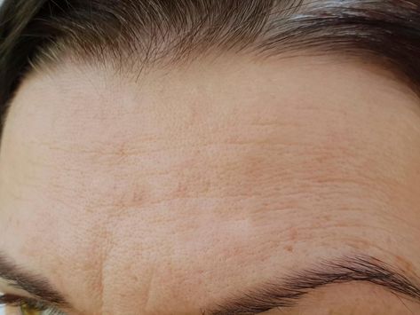 Forehead Wrinkles Remedies, Remove Forehead Wrinkles, Get Rid Of Forehead Wrinkles, Facial Wrinkles, Forehead Wrinkles, Exfoliating Cleanser, Deep Wrinkles, Acne Marks, Chemical Peel