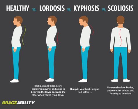 Find out what spinal curvature disorder you have: lordosis, kyphosis, scoliosis. | BraceAbility Intercostal Muscles, Lumbar Lordosis, Posture Improvement, Forward Head Posture Exercises, Inversion Therapy, Pregnancy Pain, Forward Head Posture, Posture Exercises, Mohammed Ali