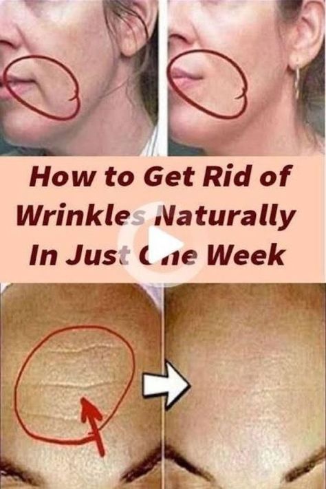 >>CHECK THIS OUT<< How to Prevent Wrinkles: Natural Anti-Aging Wrinkle Remedies Regular Skin Care Routine, Get Rid Of Wrinkles, Wrinkle Remedies, Wrinkle Free Skin, Skin Lightener, Best Skin Care Routine, Anti Aging Wrinkles, Natural Anti Aging, Face Wrinkles