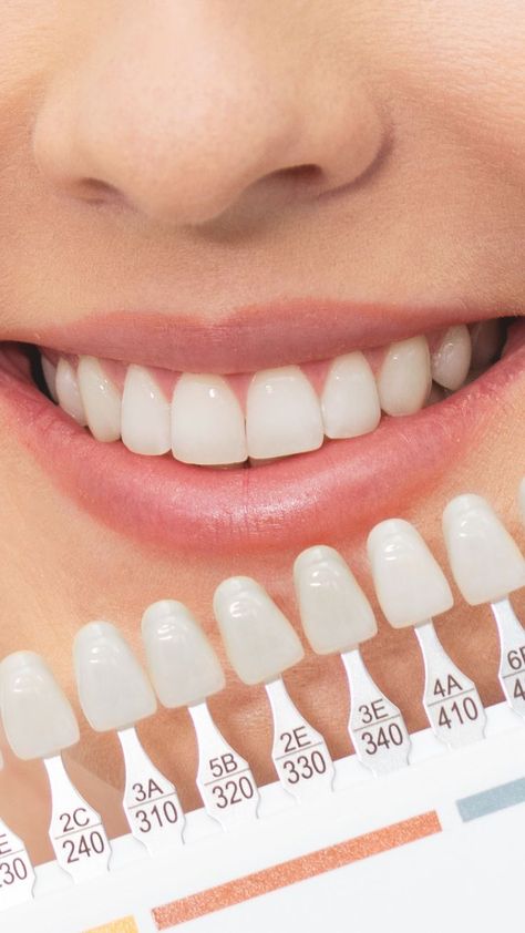 Discover the Expert Secret of Whitening Your Teeth. Read this Article Teeth Whiting At Home, Baby Tooth Decay, Dental Photos, Dental Cavities, Whiten Your Teeth, Teeth Health, Tooth Sensitivity, Gum Care, Oral Care Routine