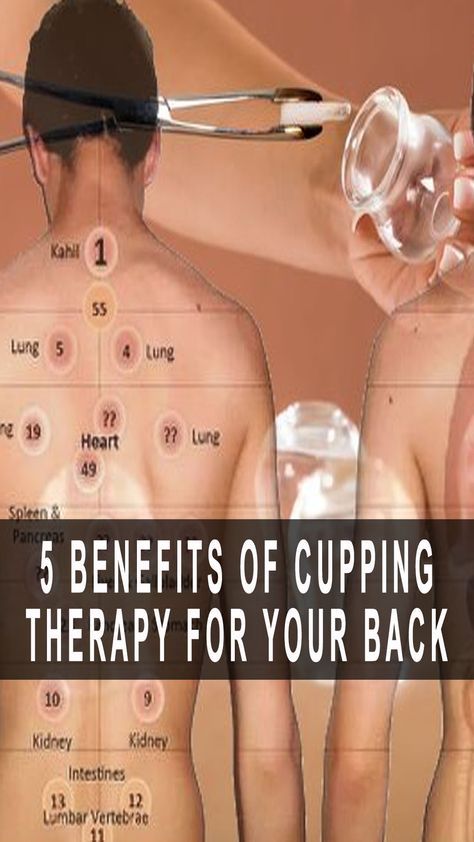 5 Benefits Of Cupping Therapy For Your Back Cupping Points Chart, Dry Cupping Therapy Chart, Cupping Placement Chart, Cupping Therapy Chart, Cupping Benefits, What Is Cupping Therapy, Cupping Points, Benefits Of Cupping, Fire Cupping