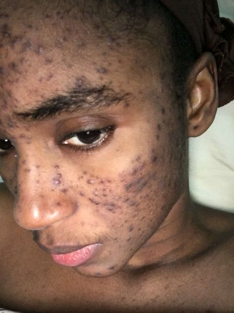 A MODEL claims that her career is ruined thanks to a Swiss skincare line which she alleges scarred her face after it caused severe acne. Mariama Diallo – who won Miss Guinea, Miss West Africa and was a contestant in the Miss World pageant – claims she started using the Makari De Suisse products in […] Ugly Dress, Mariama Diallo, Bad Acne, Severe Acne, Breast Reduction, Love Your Skin, Pretty Skin, Chemical Peel, Remove Acne