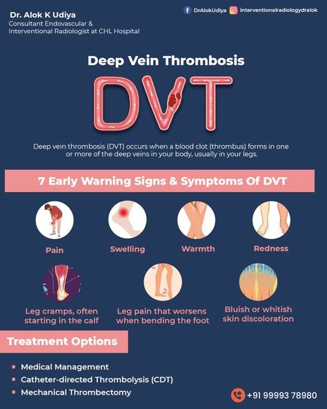 Deep vein thrombosis, or DVT, is caused by a blood clot in a deep vein and can be life-threatening. For more queries feel free to contact Dr. Alok K Udiya @ +91 99993 78980 #IndoreDoctor #dralokkudiya #dralok #Indore #CHLHospitalIndore #DVT #deepveinthrombosis #DeepVein #thrombectomy #thrombosis #veintreatment #bloodclot #BloodClotting #Postcovidsymptoms #pandemic #pulmonaryembolism #bloodclots #venousthromboembolism #stoptheclot Dvt Symptoms, Nurse Notes, Vein Thrombosis, Medical Pictures, Leg Cramps, Medication Management, Patient Education, Leg Pain, Doterra Oils