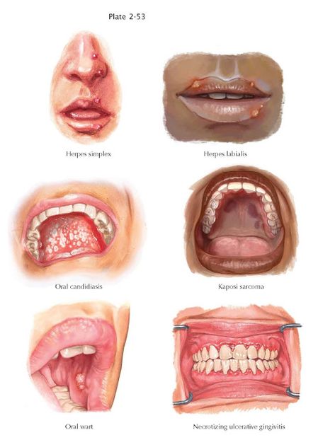 Oral Manifestations of Immunocompromised Conditions   Human immunodeficiency virus (HIV) infection, bone marrow transplantation, solid-or... Hiv Symptoms, Virus Hiv, Candida Albicans, Periodontal Disease, Bone Marrow, Nursing Student, Medical Illustration, Dental Hygiene, Oral Hygiene