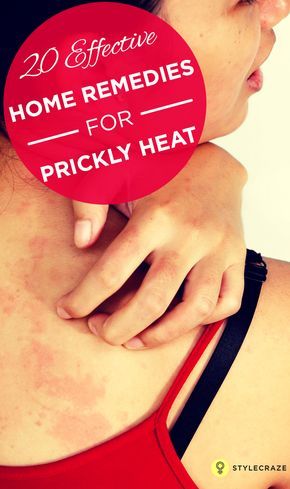 Heat Rash On Face, Heat Bumps, Heat Rash Remedy, Burn Remedies, Home Remedies For Rashes, Prickly Heat Rash, Home Remedies For Face, Ankle Strength, Medical Remedies