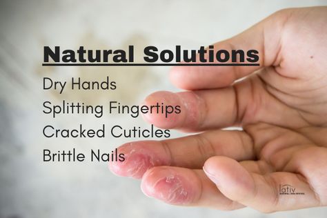 Extreme Dry Hands Remedies, Cracked Finger Tips, Wrinkly Hands, Cracked Fingertips, Dry Hands Remedy, Cracked Fingers, Dry Cracked Cuticles, Nail Guide, Hand Soak