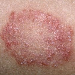 How To Treat Ringworm Fungal Rash, Yeast Infection Causes, Varicose Vein Removal, Vein Removal, Skin Rashes, Fungal Infection, Skin Disorders, Skin Problems, Digestive Health