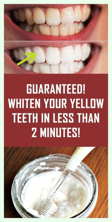 GUARANTEED! Whiten Your Yellow Teeth In Less Than 2 Minutes! Teeth Whitening Homemade, Teeth Whitening Diy, Yellow Teeth, Teeth Health, Best Teeth Whitening, Natural Teeth Whitening, Natural Teeth, White Teeth, Teeth Cleaning