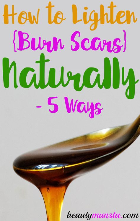 If you’re wondering how to lighten burn scars naturally, you’re in the right place! Here are 5 effective natural remedies that help! Most of us have suffered first or second degree burns at some point in our lives. You can get burned while using a curling iron or heating something on the stove. Burns can … Second Degree Burn, Curling Iron Burn, Using A Curling Iron, Burn Remedy, Burn Care, Scar Remedies, Natural Beauty Hacks, Degree Burns, Skin Burns