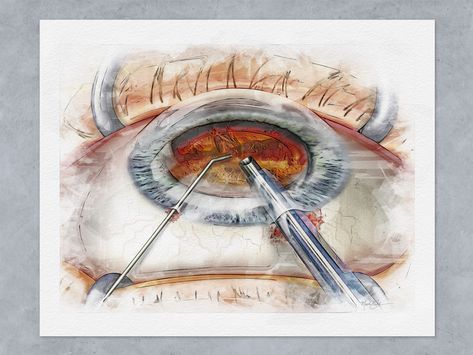 Eye Surgery Aesthetic, Ophthalmology Aesthetic, Ophthalmology Art, Blue Sketchbook, Surgery Art, Medicine Art, Eye Surgeon, Eye Clinic, Wall Art Frame