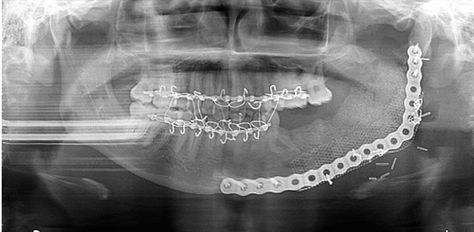 Ameloblastoma. Dentaltown Message Board > Oral & Maxillofacial Surgery  http://www.dentaltown.com/MessageBoard/thread.aspx?s=2&f=173&t=238274&v=1   #Ameloblastoma #OralAndMaxillofacialSurgery #OMS #DentalImplants #DentalCE #DentalContinuingEducation #OnlineDentalContinuingEducation #Dentaltown #Dentistry Maxillofacial Surgery, Oral Maxillofacial, Dental Humor, Patient Education, Message Board, Dental Implants, Oral Health, Surgery, To Tell