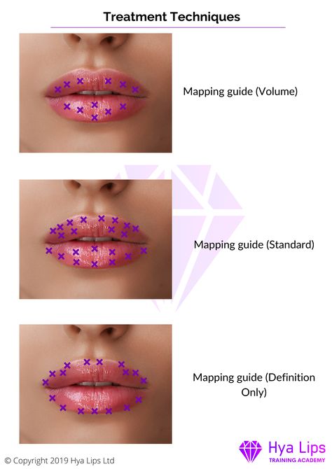 Diy Lip Plumper, Dermal Fillers Lips, Juvederm Lips, Hyaluronic Acid Lips, Thick Lips, Cosmetic Fillers, Lips Inspiration, Botox Lips, Aesthetic Dermatology