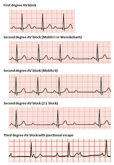 How to Interpret an ECG in Seven Steps | Online Medical Library Ekg Nursing, Ma Notes, Ekg Tech, Nursing Knowledge, Cardiology Nursing, Nursing Things, Ekg Interpretation, Medical Assistant Student, Pr Interval