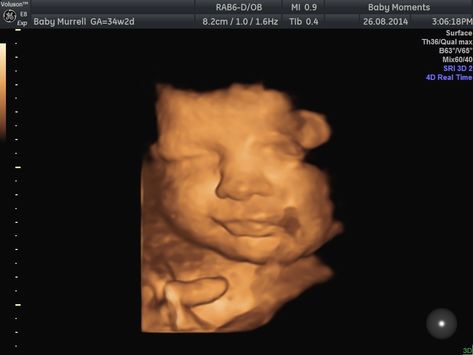 This is our 4d baby scan done our clinic Baby Moments. Look at the baby scan 16 Weeks Pregnant Belly, 16 Weeks Pregnant Ultrasound, Edwards Syndrome, Pregnancy Scan, 20 Week Scan, 3d Ultrasound, Medical Ultrasound, 4d Ultrasound, Baby Ultrasound