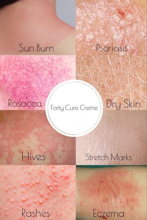 The 10 Essential & Plant Oils That Can Treat Eczema Dry Skin Causes, Skin Anatomy, Beauty Skin Quotes, Skin Facts, Skin Aesthetics, Skin Disorders, Skin Remedies, Skin Diseases, Itchy Skin