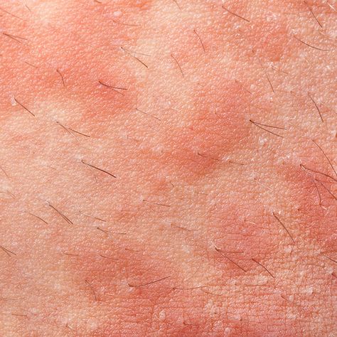 Eczema http://www.womenshealthmag.com/beauty/types-of-rashes/slide/2 Types Of Skin Rashes, Common Skin Rashes, Types Of Rashes, Treating Cystic Acne, Itchy Rash, Home Remedies For Skin, Flaking Skin, Cystic Acne, How To Treat Acne