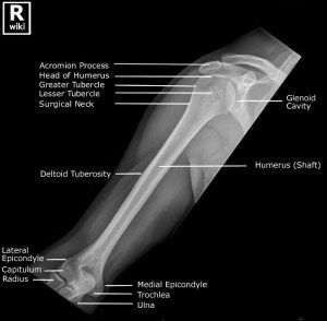 From WikiRadiography: http://radiologypics.com/2013/03/19/radiographic-anatomy-of-the-humerus/ Xray Anatomy, Radiographic Anatomy, Radiology Schools, Medical Radiography, Radiology Humor, Radiologic Technology, Radiology Student, Radiology Imaging, Radiology Tech