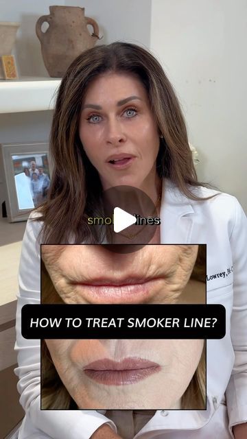 N2 Aesthetics | Medical Spa on Instagram: "Smokers lines. 

Legit the bane of my existence! So difficult to treat. 

Often times if we make them “go away” we end up with something equally displeasing about the appearance of our mouth (think 🐵)

But why do some people get them and some don’t?

Even people that don’t smoke! 🚬
Sun damage? Drinking through straws?

Actually, it’s unfortunately predisposed.
We have found that there is a direct correlation to the amount of retinacular cutis (connective tissue coming off the fascial layers and attaching to the dermis) to how “wrinkly” a person will become as they age.

If you have more retinacular cutis, you will have more wrinkles/lines. If you have less retinacular cutis, your skin will be smoother, but you will have more sagging.

Which woul Lines Around Mouth, Bane Of My Existence, Smokers Lines, Connective Tissue, Medical Spa, Sun Damage, But Why, Wrinkles, Spa