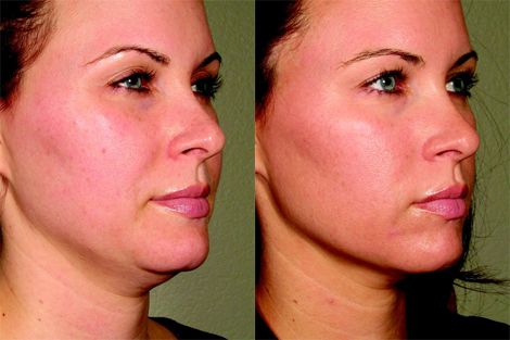 How to get rid of turkey neck? Ultherapy Non-Surgical Skin Tightening - Dr. Paul Frank - FocusOnStyle.com Face Tightening Procedures, Get Rid Of Turkey Neck, Loose Neck Skin, Skin Tightening Remedies, Skin Tightening Procedures, Natural Skin Tightening, Skin Tightening Mask, Neck Tightening, Face Lift Surgery