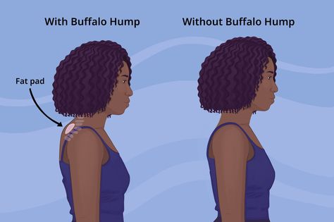 Discover the causes, prevention techniques, and effective solutions to alleviate the discomfort and pain associated with neck hump. - #buffalohump #cervicalhump #cervicalhyperlordosis #dowager'shump #excessivecurvatureoftheupperspine #Forwardheadposture #kyphosis #neckhump #poorposture #Roundedshoulders Back Hump, Cushing’s Syndrome, Dowager's Hump, Neck Hump, Cushings Syndrome, Forward Head Posture, Types Of Surgery, Metabolic Disorders, Muscle Imbalance